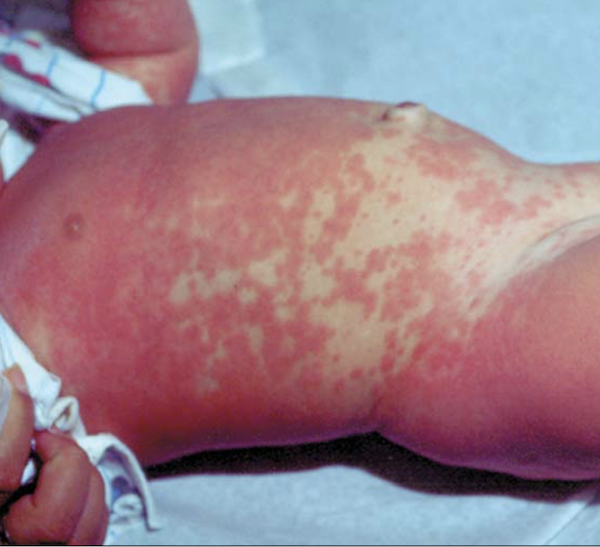 Rashes and Fever in Children Sorting Out the Potentially Dangerous